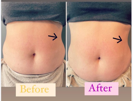before and after results of cavitation therapy