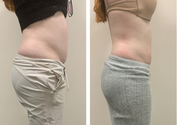 before and after results of ultrasound cavitation treatemnt