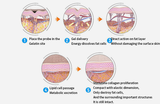 cavitation machine (3)