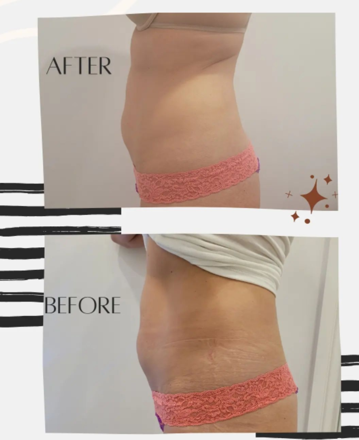 body sculpting before and after