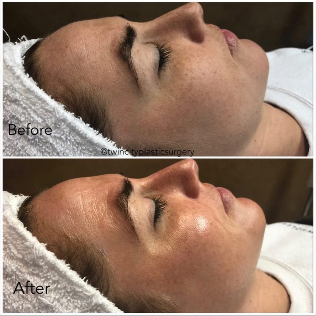 Before and After Results of Professional Hydrafacial Machine