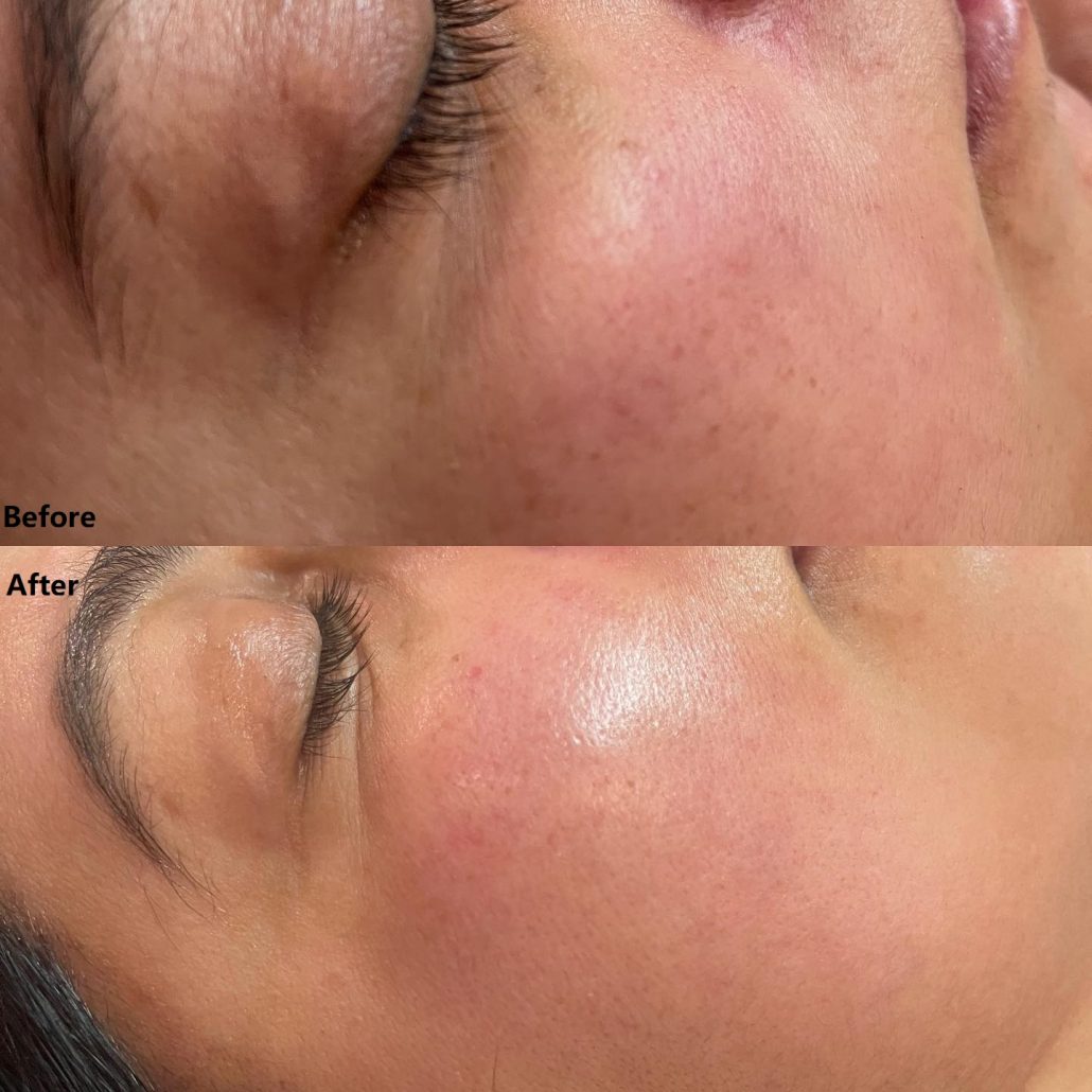 Before and After Results of Professional Hydrafacial Machine