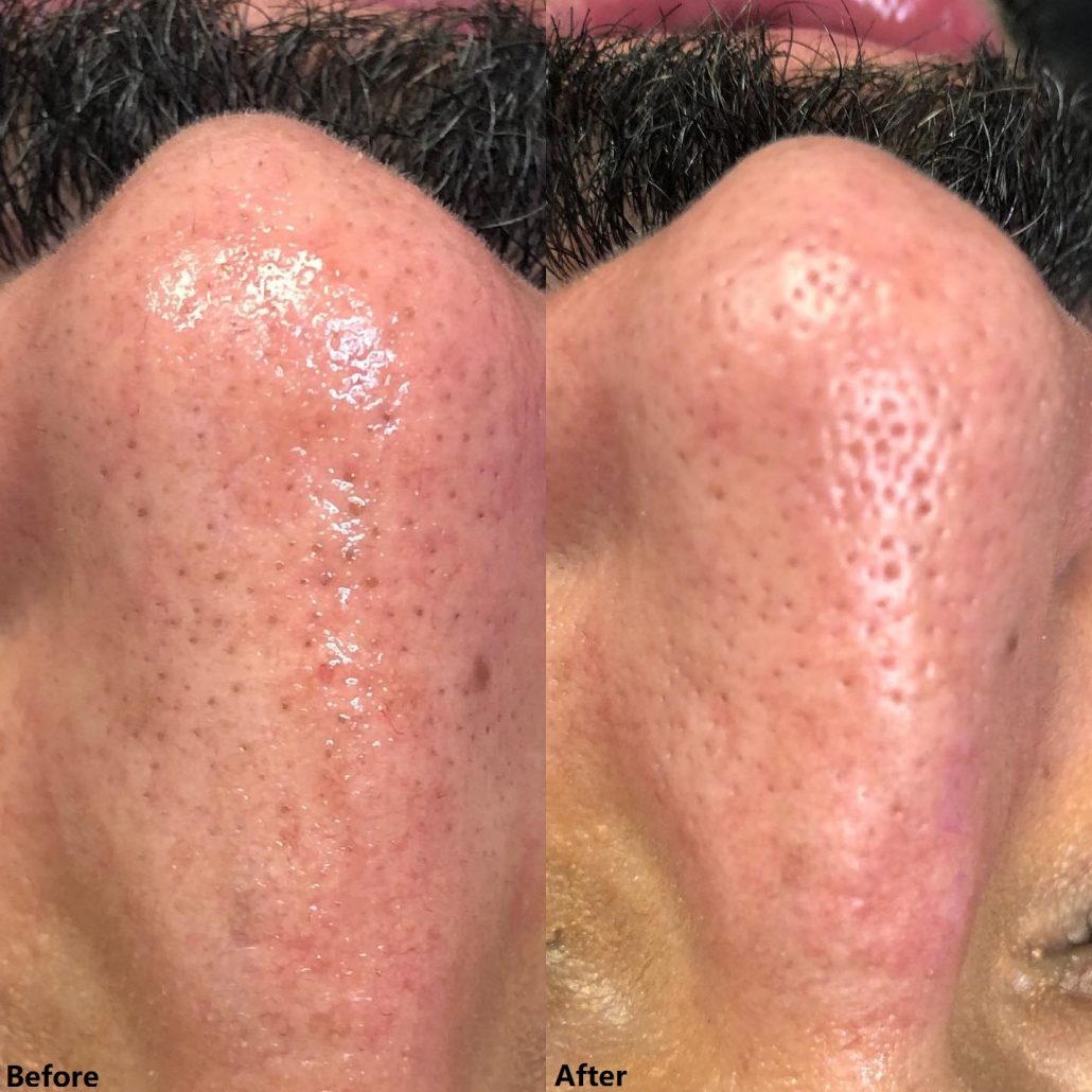 Before and After Results of Professional Hydrafacial Machine