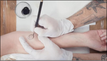 How to Get Rid of a Stick and Poke Tattoo