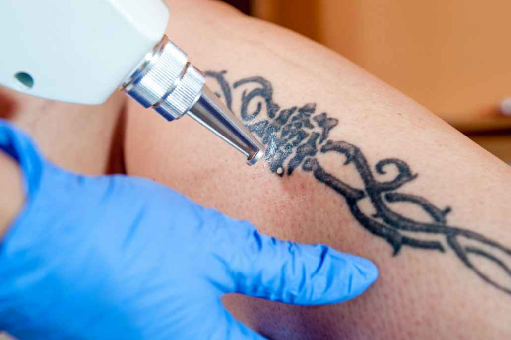 Everything to Know About Saline Tattoo Removal